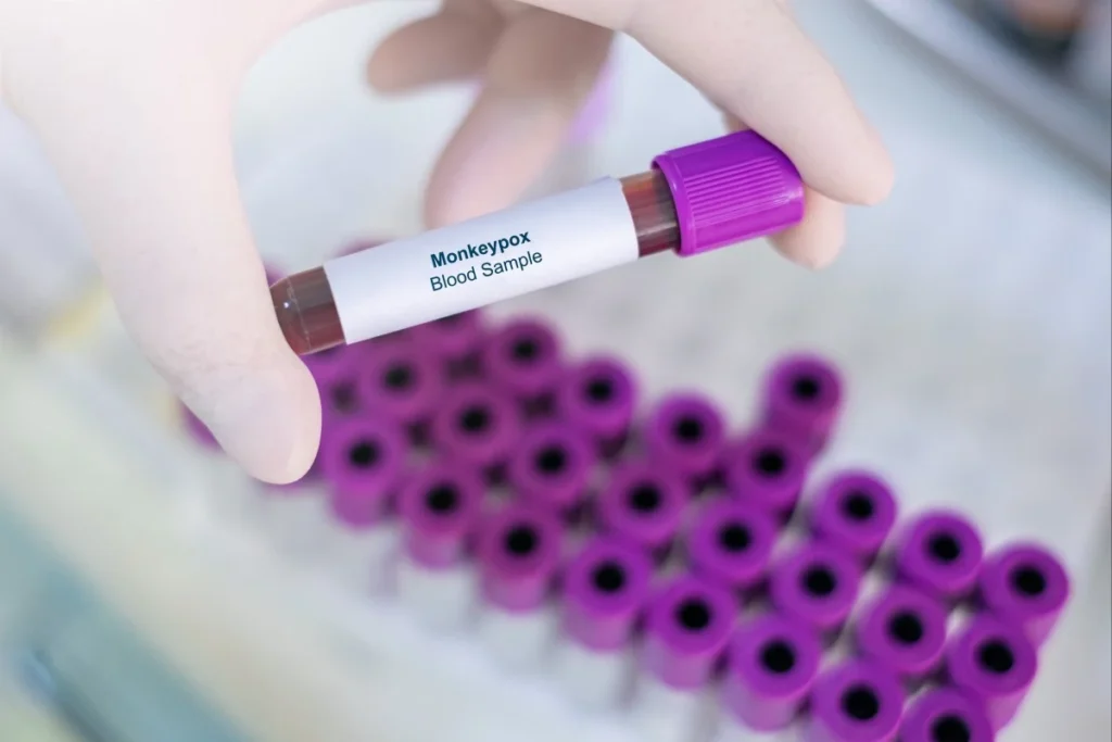 Mpox Cases Linked to Hong Kong Sauna Mpox Cases Linked to Hong Kong Sauna